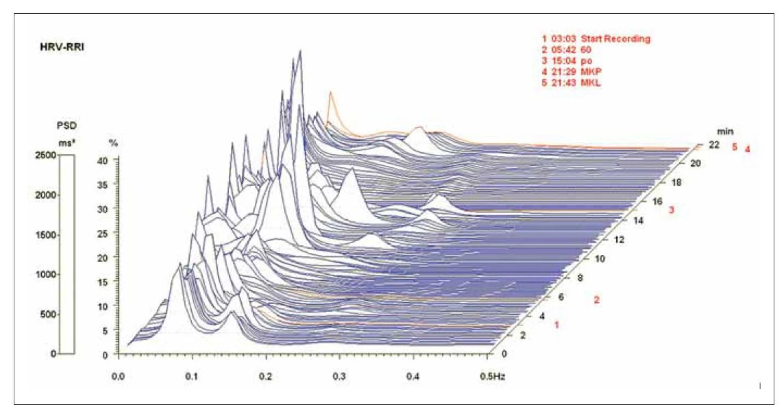 Spektrální analýza variability srdeční frekvence u osoby s kardioinhibiční reflexní bradykardickou synkopou v průběhu HUT,
Muž 32 let, bez farmakoterapie, posledních 35 sekund přes sklopením junkční rytmus<br>
Osa x frekvence, osa y PSD, osa z časový průběh HUT testu, komponenta HF (0,15–0,40 Hz), počáteční poloha vleže SUP1: HF RRI 404 ms2,
25 n.u., LF/HF 2,7, poslední 2 minuty HUT: HF RRI 142 ms2, 27,5 n.u., LF/HF 2,3, závěrečná poloha vleže SUP2: HF RRI 13 376 ms2, 32 n.u.,
LF/HF 0,9. Úsek 2 na časové ose představuje dobu náklonu (minuty 5–15).<br>
HF – vysokofrekvenční komponenta; RRI – RR-Interval je časový interval [ms] mezi dvěma kmity R na EKG; HUT – head-up tilt test; LF – nízkofrekvenční
komponenta; PSD – výkonová spektrální hustota; SUP1 – úvodní supinační poloha; SUP2 – závěrečná supinační poloha<br>
Fig. 3. Spectral analysis of heart rate variability in person with cardioinhibitory reflex bradycardic syncope during HUT; man aged
32 years, without therapy, junctional rhythm for 35 second before end of tilting.<br>
x-axis frequency, y-axis power spectral density, z-axis time course of HUT. HF component (0.15–0.40 Hz), initial supine position SUP1: HF RRI
404 ms2, 25 n.u., LF/HF 2.7, last 2 minutes of tilting: HF RRI 142 ms2, 27.5 n.u., LF/HF 2.3, final supine position SUP2: HF RRI 13,376 ms2,32 n.u.,
LF/HF 0.9. Section 2 in time axis represents tilt time (minutes 5–15).<br>
HF – high frequency component; RRI – RR-Interval describes the time interval [ms] between two R-peaks in the ECG; HUT – head-up tilt test;
LF – low frequency component; PSD – power spectral density; SUP1 – initial supine position; SUP2 – final supine position