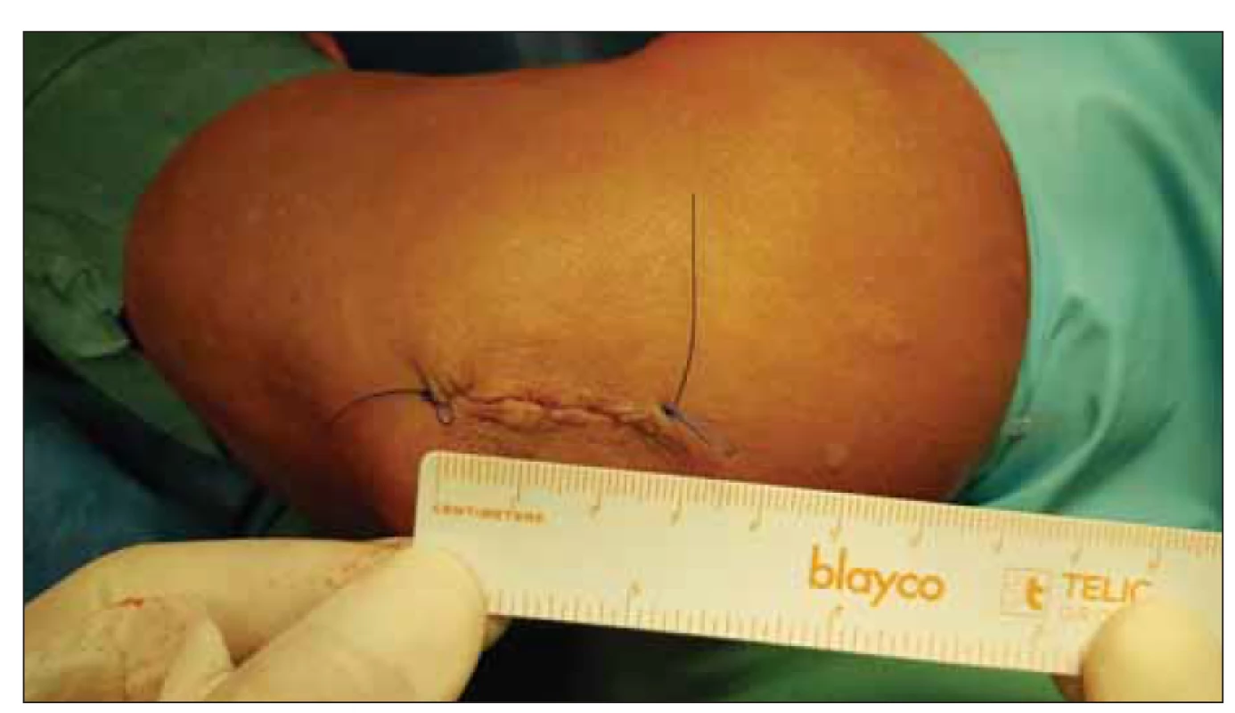 Sutura malé incize (2–3 cm) pomocí intradermálního stehu.<br>
Fig. 6. Suture of the small incision (2–3 cm) using the intradermal technique.