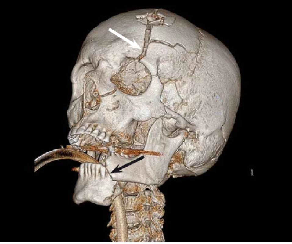 3D rekonstrukce lbi pacienta po střelném poranění. Obrázek znázorňuje devastační
poranění skeletu po suicidálním pokusu. Pacient se poranil zbraní přiloženou
pod bradu, následný výstřel způsobil dislokovanou zlomeninu dolní čelisti (černá šipka).
Bílá šipka ukazuje na frakturu čelní kosti v kontinuitě s výstřelem pokračující přes orbitu
do horní čelisti.<br>
Fig. 3. 3D skull reconstruction of the patient after a gunshot wound. The picture shows
a devastating injury of the skull. The suicidal patient put the gun behind the mental tubercle
of the mandible and shot. The bullet exited from the frontal bone. The mandible
(black arrow) and the frontal bone were shattered by the impact of the shot. The
biggest fracture of the frontal bone (white arrow) spreads from the bullet exit through
the orbit to the maxilla.