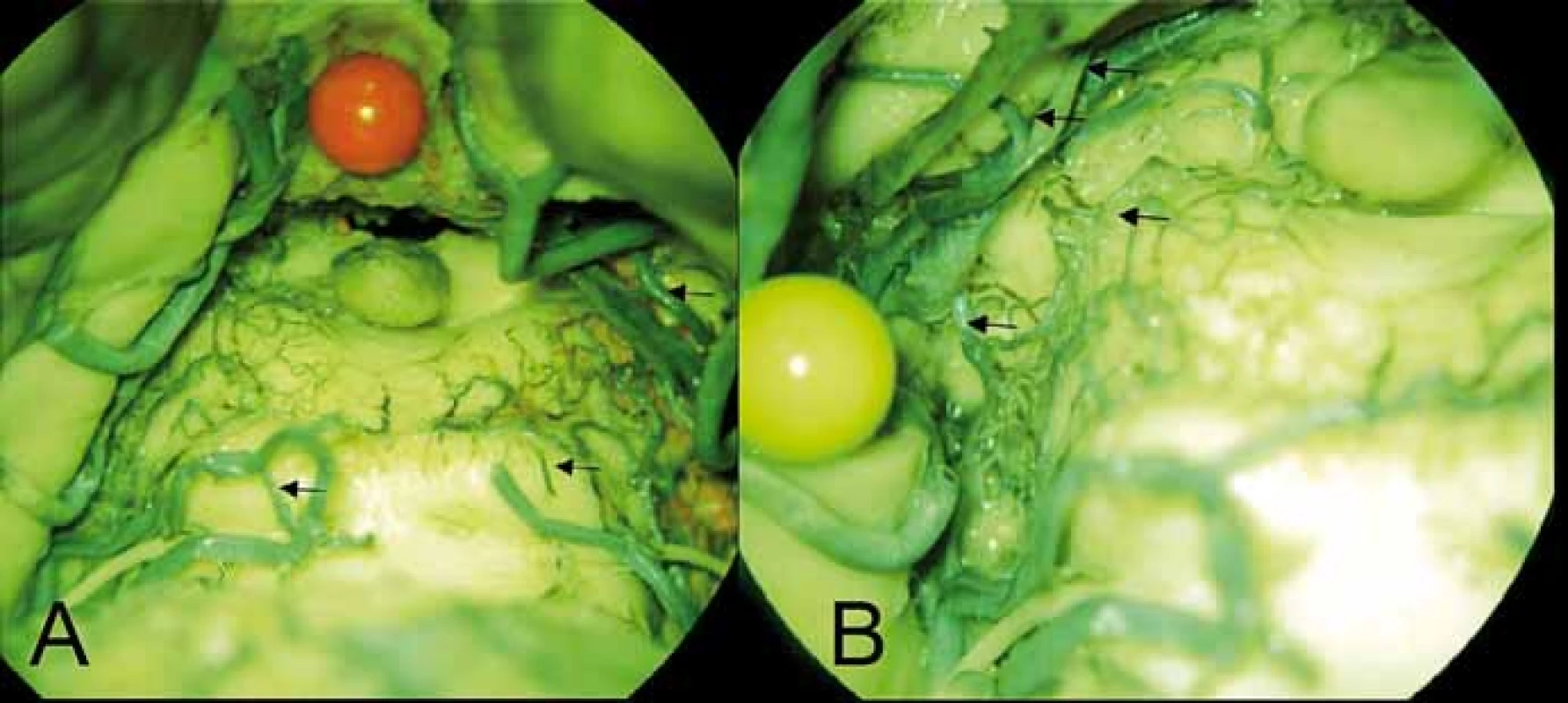 (A) Perforující větvička (šipka) pro dolní colliculus vlevo odstupují z mediálního
terminálního trunku arteria cerebelli superior vlevo, vpravo ekvivalent z rete collicullare
inferius (šipka) z arteria choroidea posterior medialis (šipka kraniálně). (B) Arteriální
síť colliculus superior vlevo z a. collicularis (šipka dole) a z arteria choroidea posterior
medialis, ze které odstupuje i talamický perforátor (2 šipky nahoře).<br>
Fig. 5. (A) Perforating branch (arrow) for the left inferior colliculus arising from the medial
terminal segment of the left superior cerebellar artery, on the right side similar to the branch
of the rete colliculare inferius (arrow) from the medial posterior choroidal artery (upper
arrow). (B) Arterial plexus of the left superior colliculus arising from the collicular artery
(lower arrow) and the from medial posterior choroidal artery. Two thalamic perforators are
also visible arising from the medial posterior choroidal artery (2 upper arrows).