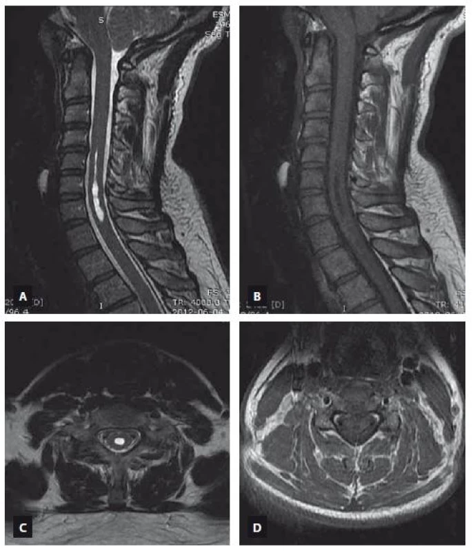 MRI scan demonstrating the syringomyelia extending from C5 to C7. T2-weighted image (A – sagittal view, C – axial view), T1-weighted image (B – sagittal view, D – axial view).<br>Obr. 3. MR snímek ukazující syringomyelii sahající od C5 k C7. T2 vážený obraz (A – sagitální rovina, C – axiální rovina), T1 vážený obraz (B – sagitální rovina, D – axiální rovina).