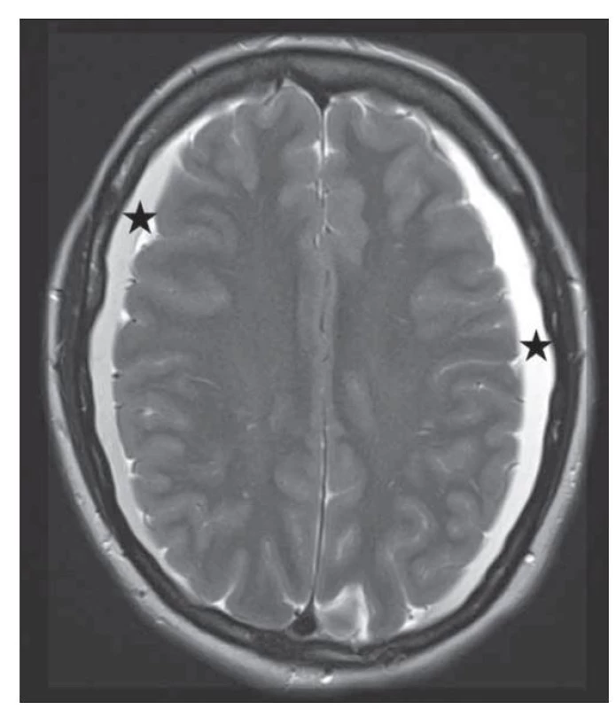 MR mozku v T2 váženém obraze s nálezem subdurálních
kolekcí oboustranně.<br>
Fig. 3. T2-weighted brain MRI with bilateral subdural collections.