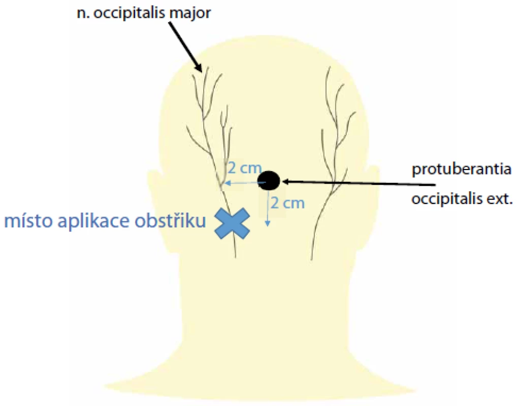 Místo obstřiku n. occipitalis major pro okcipitální neuralgii (modrý křížek) – 2 cm
laterálně a 2 cm pod protuberancia occipitalis externa.<br>
Fig. 2. Great occipitalis nerve block for occipital neuralgia (blue cross) – 2 cm lateral and
2 cm inferior to the external occipital protuberance.
