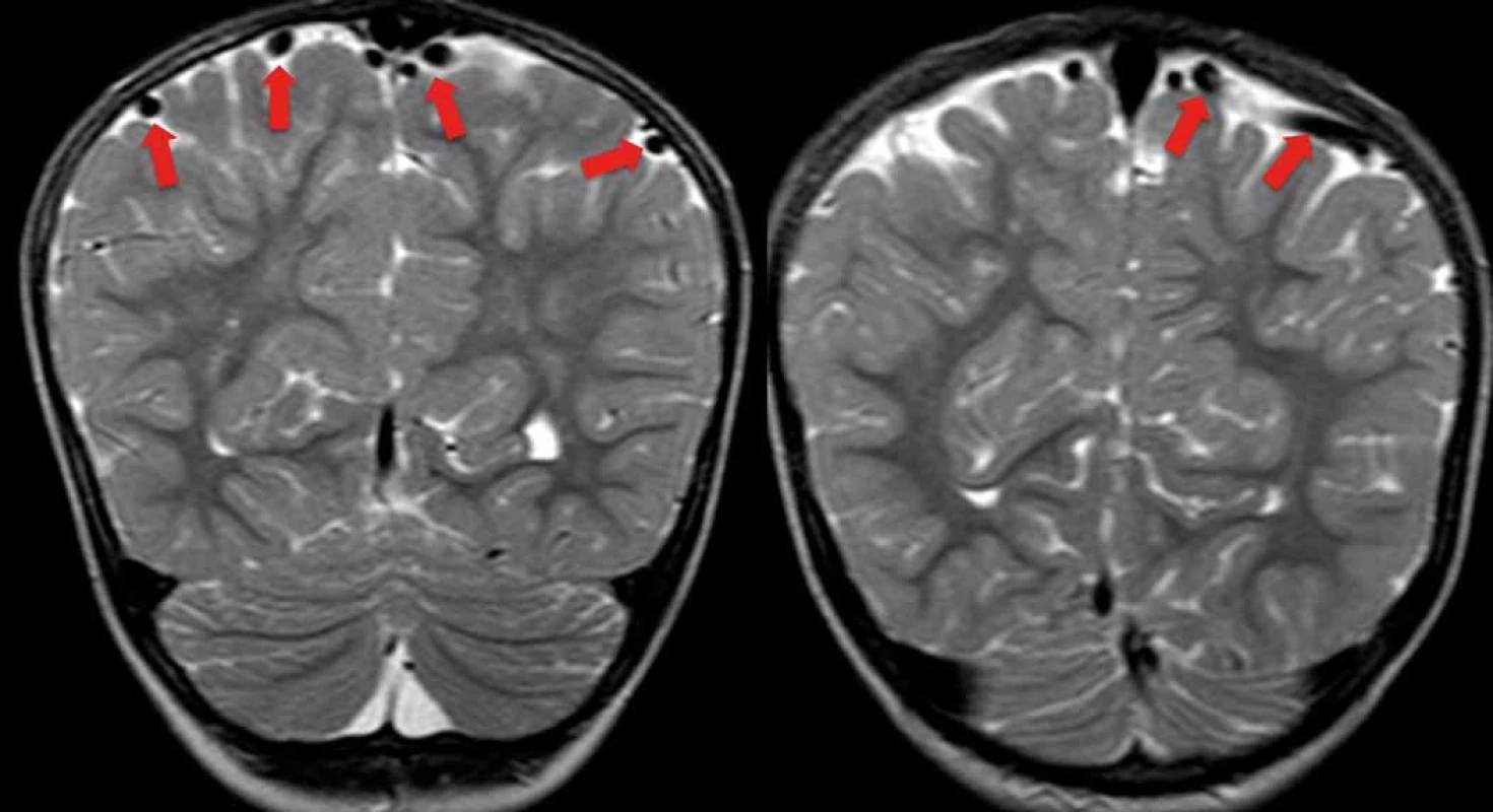 Nápadná dilatace kortikálních žil u jednoho ze symptomatických pacientů (šipky).<br>
Fig. 5. Prominent dilatation of cortical veins in one of the symptomatic patients (arrows