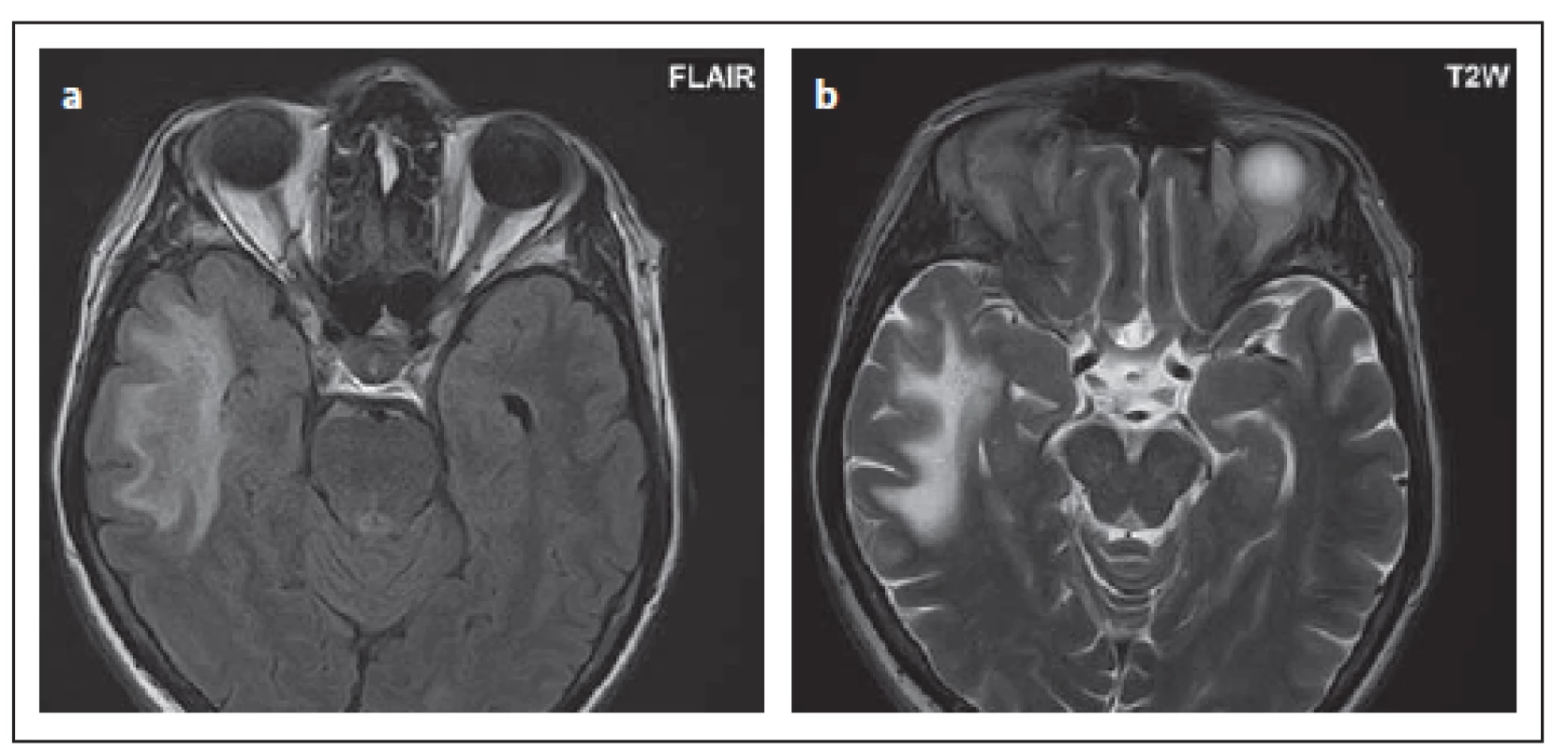 Pacient č. 2: temporálně l. dx je patrné rozsáhlé hypersignální ložisko ve FLAIR (a),
v T2 váženém obraze (b).<br>
Fig. 8. Patient No. 2: FLAIR (a) and T2WI (b) showing a big hypersignal lesion in the right
temporal lobe.