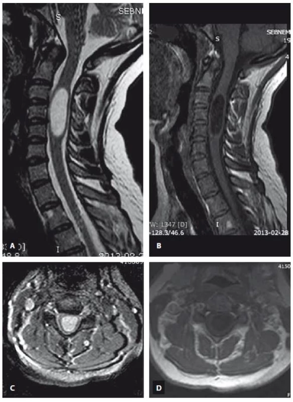 MRI scan demonstrating the intramedullary arachnoid cyst extending from C3 to C5. T2-weighted image (A – sagittal view, C – axial view), T1-weighted image (B – sagittal view, D – axial view).<br> Obr. 2. MR snímek ukazující intramedulární arachnoidální cystu sahající od C3 k C5. T2 vážený obraz (A – sagitální rovina, C – axiální rovina), T1 vážený obraz (B – sagitální rovina, D – axiální rovina).