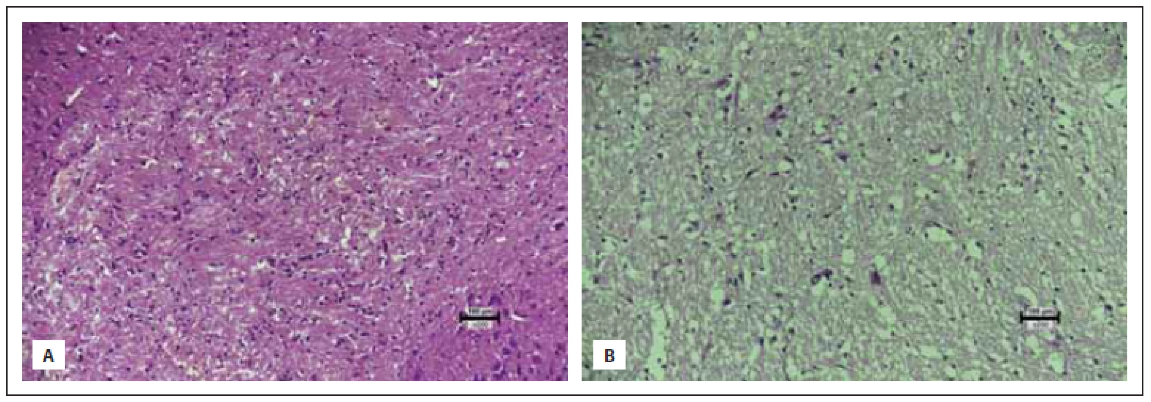 (A) Small groups of lymphoid cells in the brain tissue of the trauma group (score 0). (B) Few dispersed lymphoid cells within the
bain tissue of the sumatriptan group (score 1) (hematoxylin eosin 200×). <br> 
Obr. 3 (A) Skupinky lymfoidních buněk v mozkové tkáni ve skupině s traumatem (skóre 0). (B) Několik dispergovaných lymfoidních buněk
v mozkové tkáni ve skupině na sumatriptanu (skóre 1) (hematoxylin-eozin 200×).