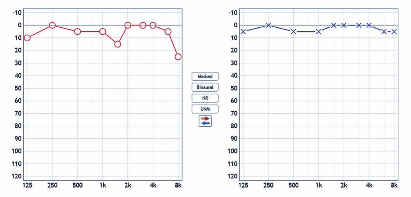 Audiometrické vyšetření. Pokles křivky vpravo (červená barva) o 5 dB (v hlubokých frekvencích) a „zub“ na frekvenci 1 500 Hz ve
srovnání se zdravou (levou) stranou (modrá barva).<br>
Fig. 1. Pure tone audiometry. This audiogram shows 5 dB hearing loss in the low frequencies in the right ear (red color) and decrease at
1,500 Hz in comparison with the left ear (blue color).