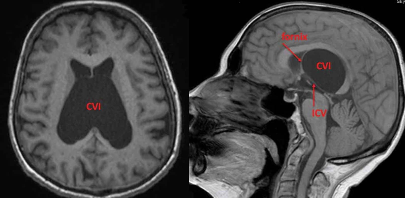 Symptomatická cysta CVI. Fornixy jsou vytlačeny dopředu a ICV dolů spolu se stropem III. komory.
CVI – cavum veli interpositi; ICV – vnitřní mozková žíla<br>
Fig. 4. Symptomatic CVI cyst. Fornices are elevated anteriorly and ICVs are pushed down together with the roof of the IIIrd ventricle.
CVI – cavum veli interpositi; ICV – internal cerebral vein