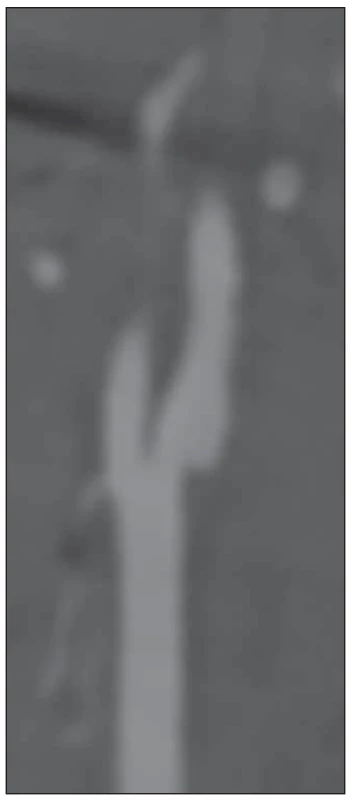 CTA sagitální rekonstrukce prokazující
prominující karotický web ze zadní stěny karotického bulbu. <br> 
Fig. 1 CTA sagittal reconstruction
showing a shelf-like defect from the posterior
wall of the carotid bulb.
