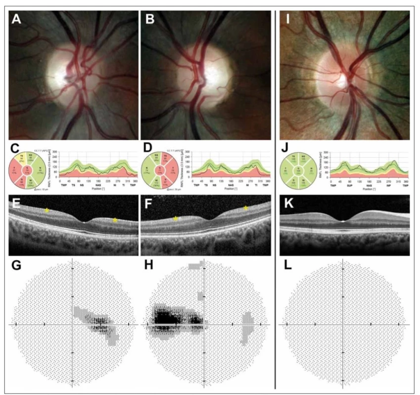 Oční nálezy u pacienta s dominantní atrofií optiku asociovanou s mutací v OPA1 genu.<br>
Barevná fotografi e papily zrakového nervu pravého (A) a levého (B) oka s bledým temporálním kvadrantem u 29letého muže s manifestací
onemocnění v 18 letech. Měření tloušťky vrstvy nervových vláken peripapilárně dokládá redukci tloušťky vrstvy nervových vláken v temporální
polovině (žluté a červené pásmo) pravého (C) a levého (D) oka. Vymizení vrstvy gangliových buněk sítnice (označeno hvězdičkou) v perifoveální
oblasti pravého (E) a levého (F) oka na horizontálním skenu z optické koherenční tomografi e se spektrální doménou. Zorné pole s caekocentrálním
skotomem pravého (G) a levého (H) oka. Pravé oko zdravého kontrolního jedince pro srovnání (I–L).<br>
Fig. 1. Ocular fi ndings in a patient with dominant optic atrophy caused by mutation in the OPA1 gene.<br>
Colour fundus photographs showing the right (A) and (B) left optic disc of a 29-year-old male with disease onset at the age of 18 years; note
the pale appearance in the temporal quadrant. Retinal nerve fi bre layer measurements showing reduction in thickness (yellow and red band)
in the right (C) and left (D) eye and retinal ganglion cell layer loss (marked with an asterisk) in the perifoveal area of the right (E) and left (F) eye
on a horizontal scan obtained by spectral domain optical coherence tomography. Corresponding centrocaekal scotomas in the right (G) and
left (H) eye. Right eye of a healthy control individual for comparison (I–L).