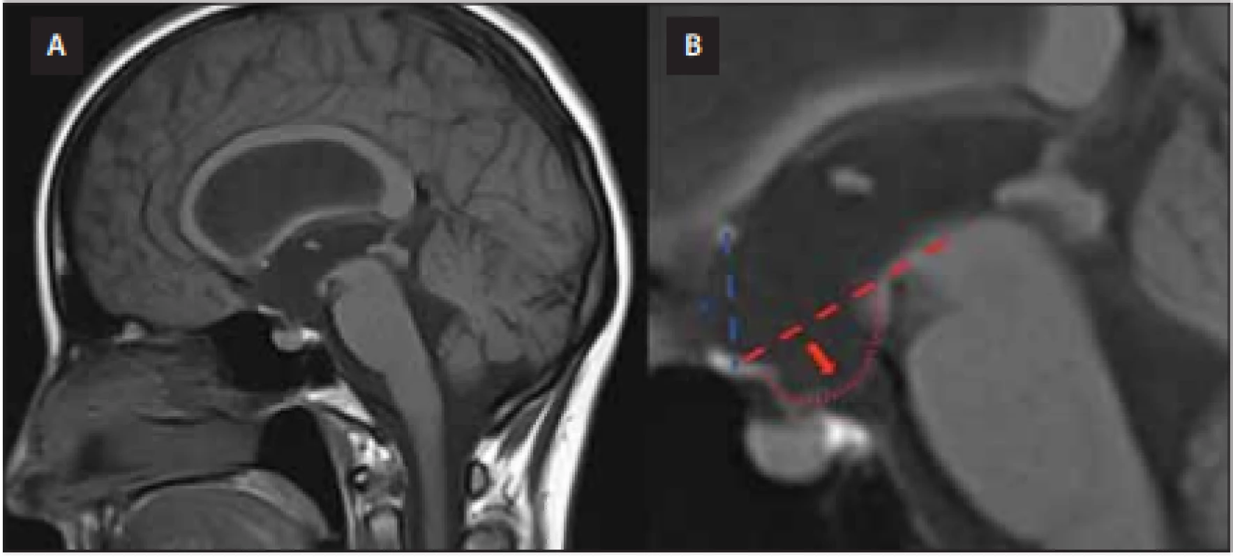  MR mozku, T1 vážený obraz, sagitální projekce. (A) Zobrazení vyjádřeného bowingu 
třetí komory. (B) Detailní pohled na třetí komoru. Spodina třetí komory (označena červenou 
šipkou) přesahuje referenční linii rozpínající se mezi horní častí tegmenta mesencefala a optickým chiasma (červená, přerušovaná čára) se současným vyklenutím lamina terminalis 
(označeno *) přesahujícím spojnici mezi chiasma a přední komisurou (modrá čára).<br>
Fig. 2. Brain MRI, T1-WI, sagittal projection. (A) A neuroimaging study demonstrating 
third ventricular bowing. (B) A third ventricle is shown in detail. Deformation of the third 
ventricle floor (red arrow) below a defi ned reference line drawn from the middle of the 
optic chiasm to the superior-most aspect of the midbrain tegmentum (red, dashed line) 
together with anterior bulging of the lamina terminalis (marked by *) over the line drawn 
between the chiasma and the anterior commissure (blue line).