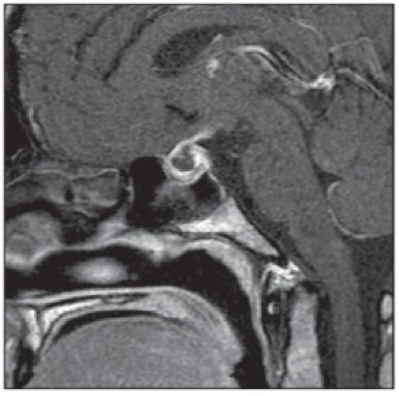 Apoplexie hypofýzy. Vyšetření MR,
sagitální T1 snímek s aplikací kontrastní
látky – postkontrastní nehomogenní
sycení při objemovém zvětšení
hypofýzy. <br>
Fig. 4. Pituitary apoplexy. MRI scan,
sagittal contrast enhanced T1-weighted image – enlarged pituitary gland
with post-contrast nonhomogeneous
enhancement.