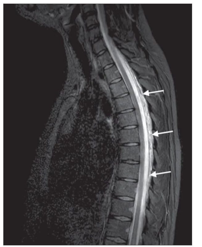 MR páteře T2 váženém STIR obraze zobrazující dorzální
longitudinální epidurální kolekci v úrovni Th2 -10.<br>
Fig. 4. T2-weighted STIR spine MRI showing dorsal longitudinal
epidural fluid collection at the level of T2 -10.