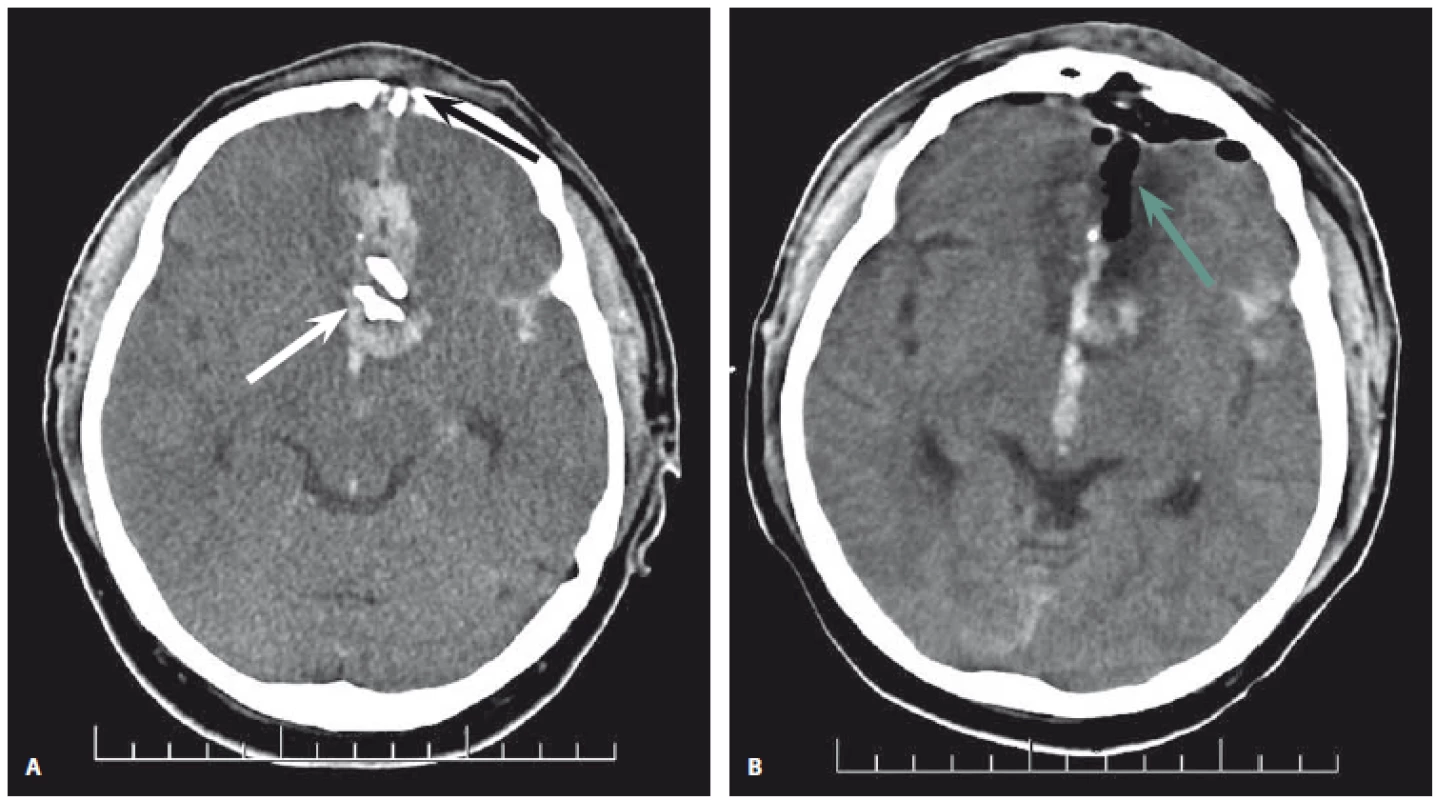 1. CT mozku 50letého pacienta po zástřelu jateční pistolí. Vlevo (1A) je znázorněn předoperační axiální snímek. Vstřel je umístěn
v čelní kosti (černá šipka). Střelný kanál tečuje sinus sagittalis superior a proniká do mozkové tkáně paralelně s falxem. Kanál je vyplněn
krví a jsou v něm uloženy úlomky kostí (bílá šipka). Vpravo (1B) je pooperační axiální snímek. Je patrná parciální evakuace hematomu
a odstranění kostních úlomků. Dutina je vyplněna vzduchem (zelená šipka). Reziduální interhemisferální hemoragie zůstává nedotčena.
Hypodenzita v okolí střelného kanálu je způsobena posttraumatickou ischemií a otokem okolní mozkové tkáně.<br>
Fig. 1. CT scan of a 50-year-old patient after self-inflicted captive bolt gun injury. Left (1A): preop axial scan. The entry of the projectile
is in the frontal bone (black arrow). The trajectory caused tangential involvement of the superior sagittal sinus and penetrated the
brain tissue parallel to the falx. The trajectory is filled with blood and bone fragments (white arrow). Right (1B): postop axial scan. The
bullet trajectory is filled by air (green arrow), partial evacuation of hematoma is visible and bone fragments are removed. The residual
interhemispheric hemorrhage is left intact. Perilesional hypodensity is due to post-traumatic ischemia and brain edema.