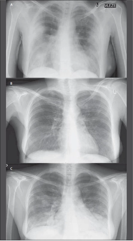 RTG snímky plic. Na snímku nahoře z 15. 4. 2020 (A) a dole z 9. 6. 2020 (C) jsou patrné oboustranné zánětlivé infiltrace, snímek uprostřed z 21. 5. 2020 (B) je bez patologického nálezu. <br>
Fig. 1. X-rays of the lungs. The image above from April 15, 2020 (A) and at the bottom 
from June 9, 2020 (C) show bilateral inflammatory infi ltrations, the image in the middle 
from May 21, 2020 (B) without pathological fi ndings.