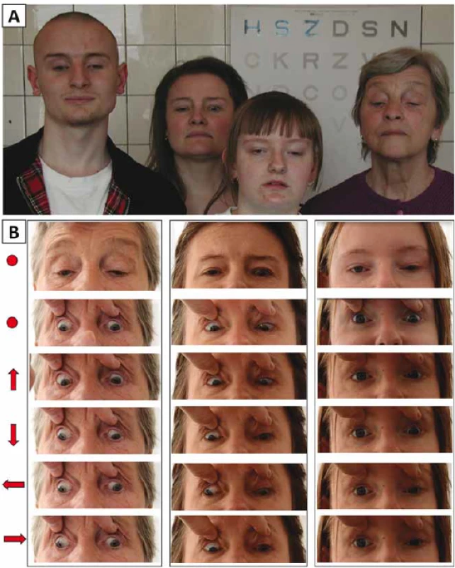 Dokumentace okohybné poruchy u 3 příslušníků rodiny s diagnózou kongenitální
fibrózy zevních okohybných svalů. (A) Čtyři vyšetřovaní rodinní příslušníci při pohledu
vpřed, nápadné je vynucené postavení hlavy se záklonem, u očí s ptózou vyhlazení
orbitopalpebrální rýhy. (B) Různé pohledové směry jsou vyznačeny šipkou, přímý
pohled vpřed kolečkem (bez a s pasivním zvednutím víček).<br>
Fig. 1. Documentation of eye movement abnormality in 3 members of one family with
congenital fi brosis of the extraocular muscles. (A) Four examined family members looking
straight ahead with a marked compensatory backward tilting of the head (B) Different
gaze positions are indicated by arrows; primary gaze position (with and without
passive lid elevation) is indicated with a dot.