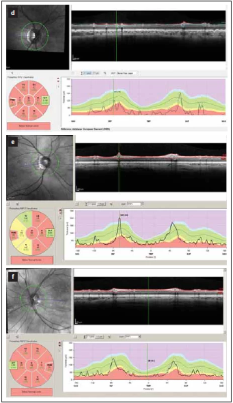 Tloušťka vrstev RNFL v peripapilární
oblasti měřená optickou koherenční tomografií.
Hodnoty mezi 5. a 95. percentilem
normy jsou kódovány zeleně, mezi 1. a 5. percentilem
normy žlutě a pod 1. percentilem
normy červeně.<br>
(d–f) zobrazují nálezy po proběhlém zánětu
zrakového nervu u neuromyelitis optica a onemocnění
jejího širšího spektra. V těchto očích je
zjevný výrazný pokles tloušťky RNFL ve všech
peripapilárních segmentech (červeně a žlutě).<br>
Fig. 1. Peripapillary thickness of RNFL as measured
by optical coherence tomography. Results
of RNFL thickness are color coded with
values between 5th and 95th percentile of normal
coded in green, values between 1st and
5th percentile yellow and values below 1st percentile
red.
(d–f) show a loss of RNFL in all peripapillary
segments (yellow and red) in patients post
optic neuritis in neuromyelitis optica spectrum
disorders.