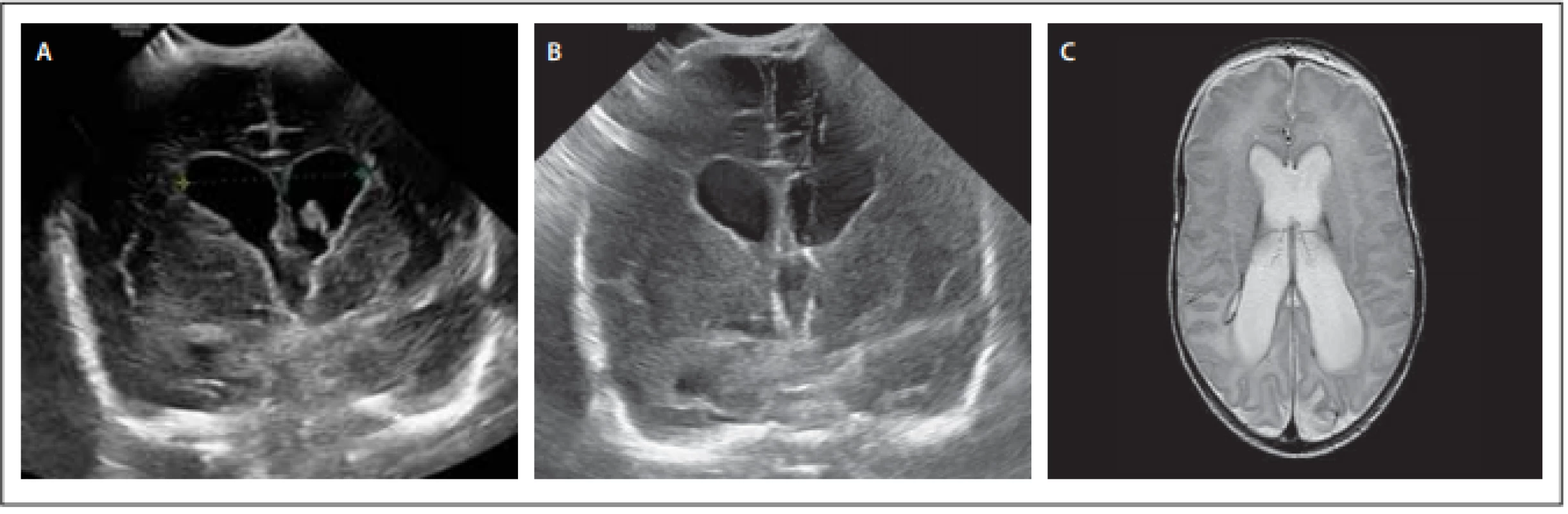 Pacient 2 – (A) předoperační sonografie ve fázi parciální redukce objemu koagula, ale progrese šíře komor; (B) pooperační UZ
s viditelným katétrem; (C) MR mozku s odstupem 3 měsíců s obrazem netenzní dilatace komorového systému.<br>
Fig. 2. Male patient 2 – (A) preoperative sonography in the phase of partial reduction of clot volume, but progression of ventricular width; (B) postoperative sonography with visible catheter; (C) MRI of the brain 3 months later with an image of non-tension dilatation of
the ventricular system.