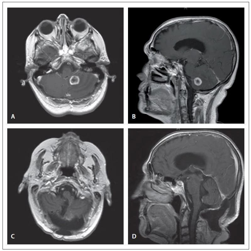 MRI of the brain demonstrates the lesion in the left cerebellar hemisphere
with a heterogeneous postcontrast enhancement in axial (A) and sagittal (B)
T1-weighted images. Postoperative T1-weighted postcontrast axial (C) and sagittal (D)
images reveal the total excision of the tumor.<br>
Obr. 1. Předoperační MR mozku zobrazuje lézi v levé cerebelární hemisféře s heterogenním
postkontrastním enhancementem v axiálním (A) a sagitálním (B) T1 váženém obrazu.
Pooperační T1 vážené postkontrastní axiální (C) a sagitální (D) obrazy zobrazují
úplnou excizi nádoru.
