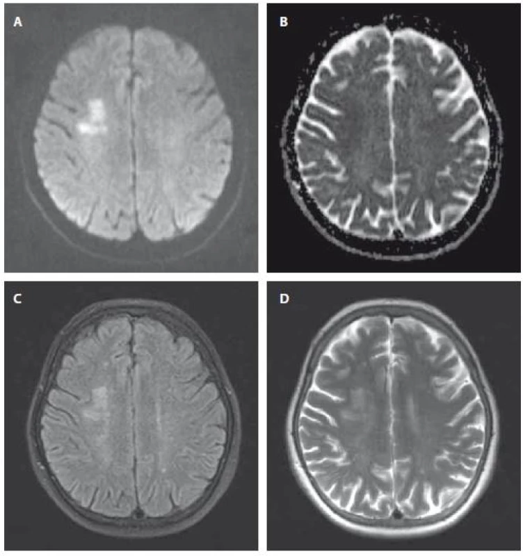 MR mozgu u pacienta s akútnym/subakútnym SCI parietálne vpravo.
A – DWI; B – ADC obraz; C – FLAIR; D – T2 váženie.
ADC – aparentný difúzny koeficient; DWI – difúziou vážený obraz; FLAIR – fluid-attenuated
inversion recovery; SCI – tichý mozgový infarkt<br>
Fig. 1. MRI in a patient with acute/subacute SCI in the right parietal region.
A – DWI; B – ADC image; C – FLAIR; D – T2-weighted.
ADC – apparent diffusion coefficient; DWI – diffusion weighted imaging; FLAIR – fluid-attenuated
inversion recovery; SCI – silent cerebral infarction