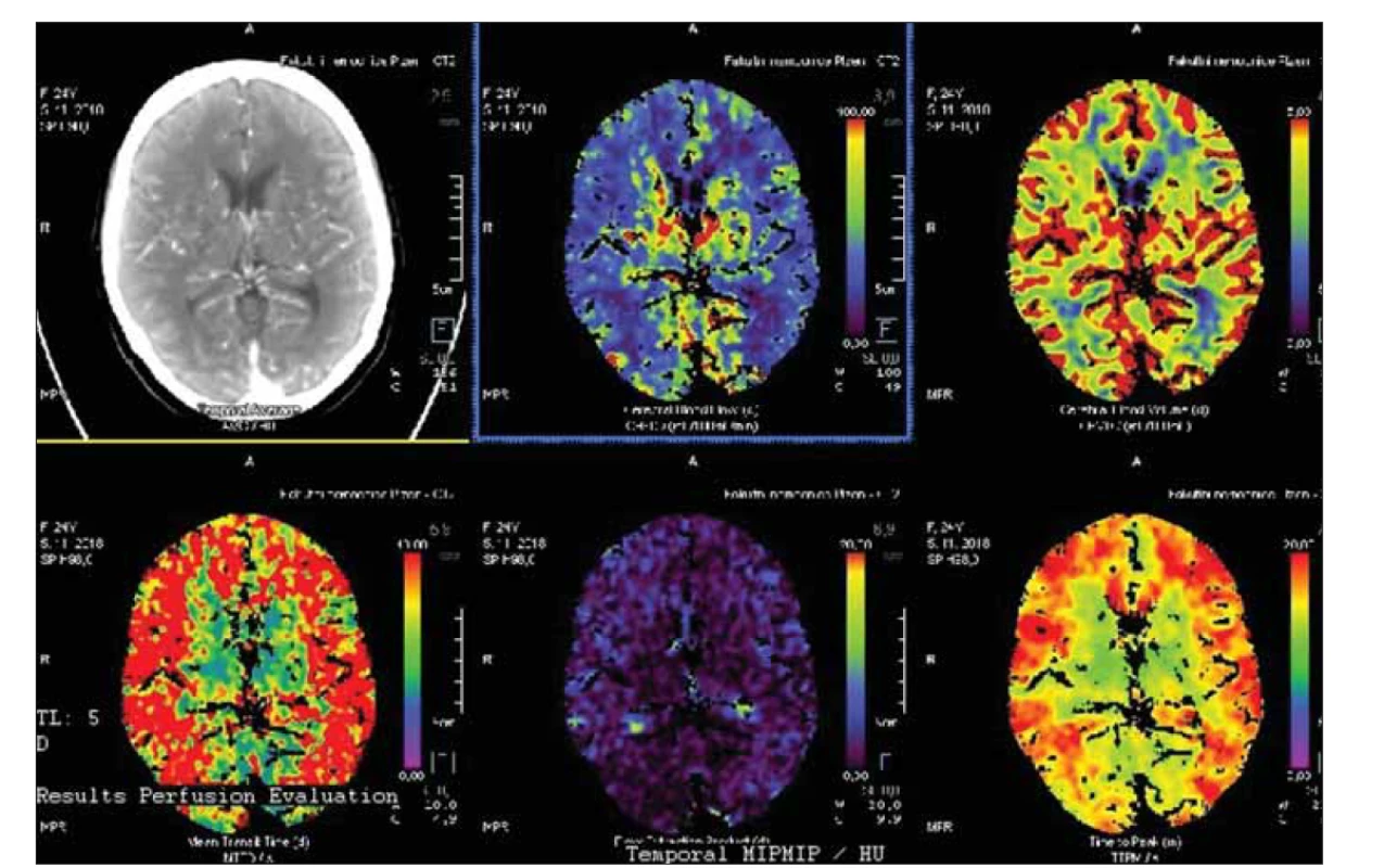 Bazální perfuzní CT s významným oboustranným snížením mozkového krevního průtoku.<br>
Fig. 3. Basal perfusion CT with signifi cant bilateral decrease of cerebral blood fl ow.