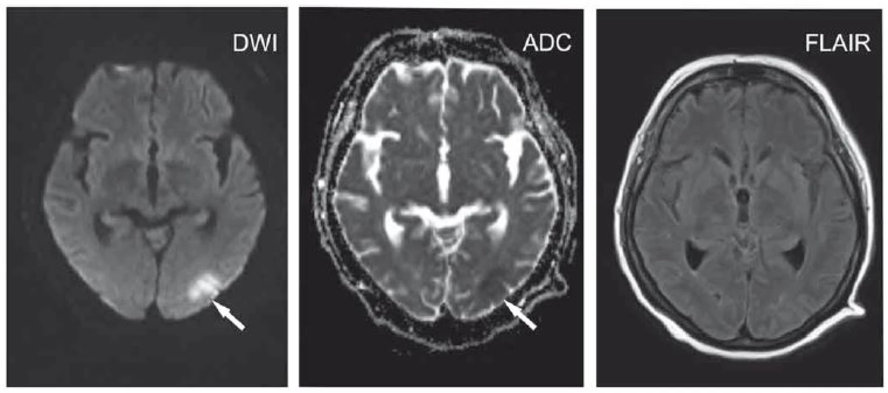 Polymorbidní pacientka ve věku 65 let s kvantitativní poruchou vědomí charakteru až soporu/komatu v terénu demence.<br>
Okcipitálně vlevo okrsek se zvýšeným signálem na DWI a sníženým signálem na ADC odpovídající restrikci difuze (šipky), na FLAIR není patrná
změna intenzity signálu. Velmi časná ischemie.<br>
ADC – aparentní difuzní koeficient; DWI – difuzí vážený obraz; FLAIR – inverzní zobrazení s potlačením signálu tekutiny<br>
Fig. 1. A 65-year-old polymorbid woman suffering from dementia with a quantitative disorder of consciousness characterized by stupor/
coma. Located occipitally on the left, an area hypersignal on DWI and hyposignal on ADC corresponds to diffusion restriction (arrows)
with no changes on FLAIR. Hyperacute ischemia.<br>
ADC – apparent diffusion coefficient; DWI – diffusion-weighted image; FLAIR – fluid attenuated inversion recovery