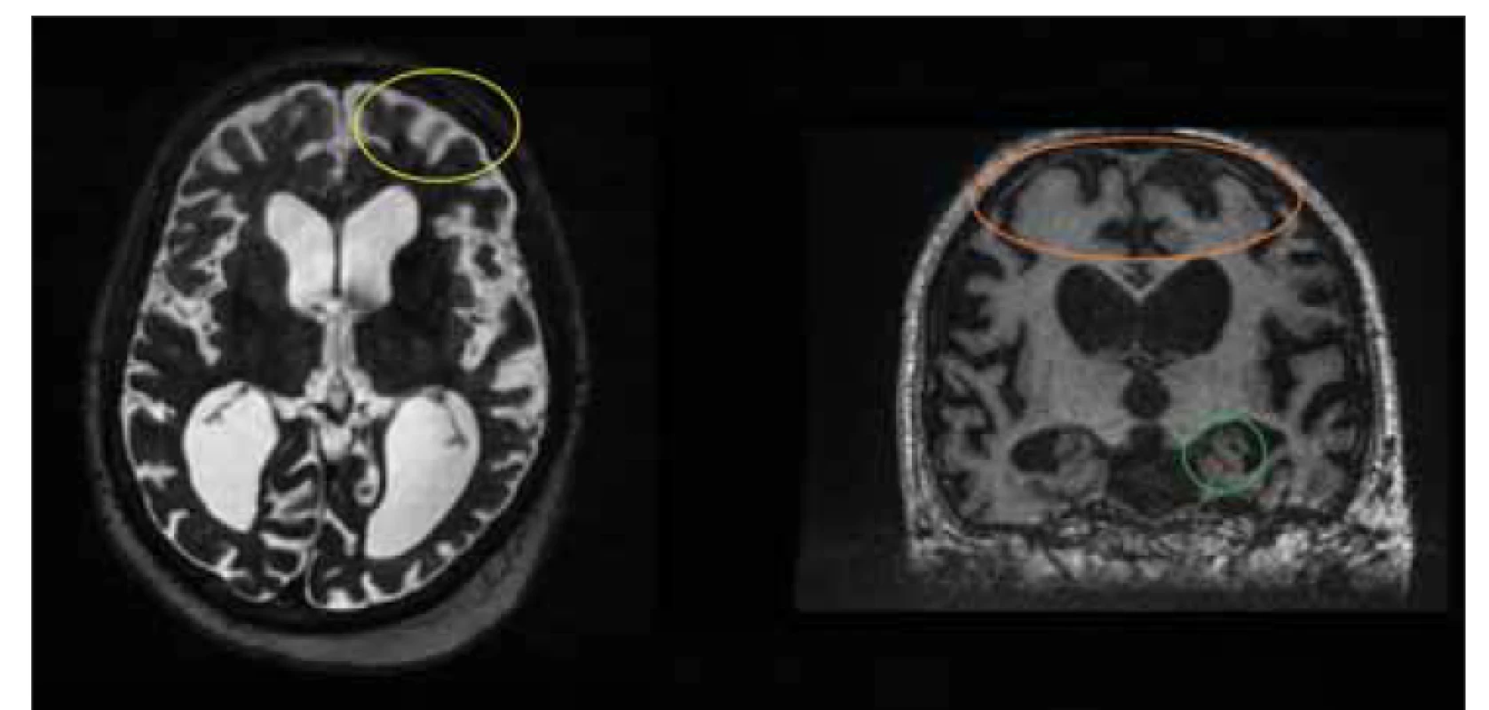 MR, T2-vážený obraz, axiální rovina, T1-vážený obraz, frontální rovina. Pacient v
rámci vyšetřování pro suspektní idiopatický normotenzní hydrocefalus. Klinické symptomy
nasvědčovaly spíše Alzheimerově chorobě. Funkční testování bylo negativní. Pacientovi
byla posléze diagnostikována Alzheimerova choroba. Povšimněte si kortikální
atrofie (žlutý kruh), atrofie hippocampu (zelený kruh) a volných subarachnoidálních prostor
na konvexitách (oranžový kruh).<br>
Fig. 7. MRI, T2-weighted image, axial plane, T1-weighted image, coronal plane. Patient
under testing for suspected idiopathic normal pressure hydrocephalus. Clinical symptoms
were more indicative of Alzheimer‘s disease. Functional testing was negative. The
patient was subsequently diagnosed with Alzheimer‘s disease. Note the cortical atrophy
(yellow circle), hippocampal atrophy (green circle), and free subarachnoid spaces on
convexities (orange circle).