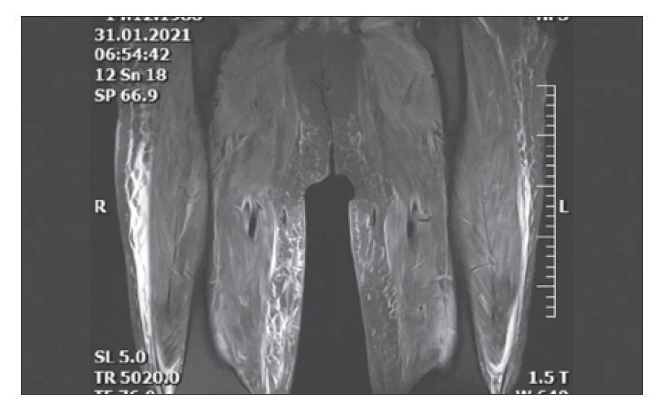 MR stehen z 31. 1. 2021 (sekvence T2 kor 3D space, STIR) – difuzní edém svalů
a podkoží.<br>
STIR – short tau inversion recovery<br>
Fig. 1. Thighs MRI from January 1, 2021 (T2 kor 3D space, STIR sequences) – diffuse
edema of muscles and subcutaneous tissue.<br>
STIR – short tau inversion recovery