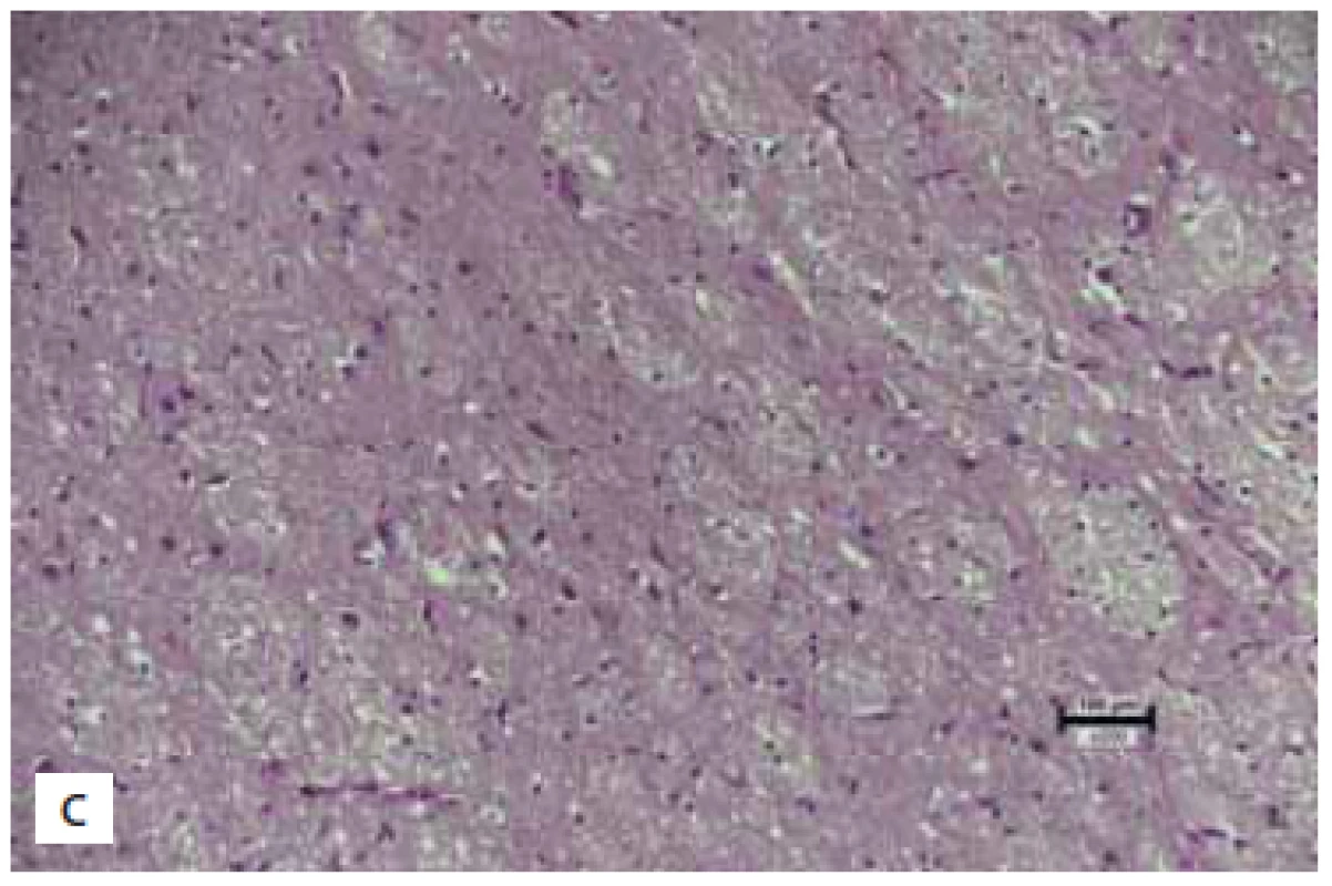 (A) Normal brain tissuie in the control group (score 3). (B)
Significant gliosis in the trauma group (score 0). (C) Mild gliosis
in the sumatriptan group (score 2) (hematoxylin eosin 200×). <br> 
(A) Normální mozková tkáň v kontrolní skupině (skóre 3).
(B) Významná glióza ve skupině s traumatem (skóre 0). (C) Mírná
glióza ve skupině na sumatriptanu (skóre 2) (hematoxylin-eozin
200×).