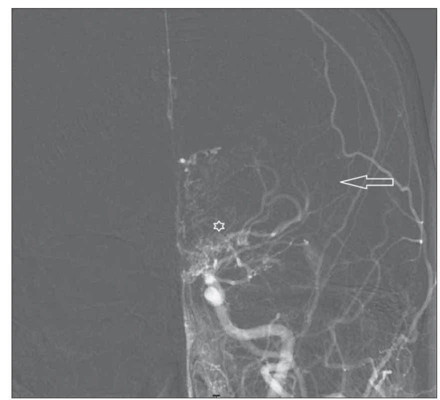 DSA levé karotidy před revaskularizací – předozadní projekce. Šipka ukazuje oblast
arteria cerebri media, kde za fyziologických poměrů je bohatá vaskularizace. Hvězdička
zobrazuje bazální kolaterály.<br>
Fig. 2. Left carotid DSA before revascularization – anterior-posterior projection. Arrow
shows the middle cerebral artery territory where vascularization is abundant under physiological
conditions. Asterix shows basal collaterals.