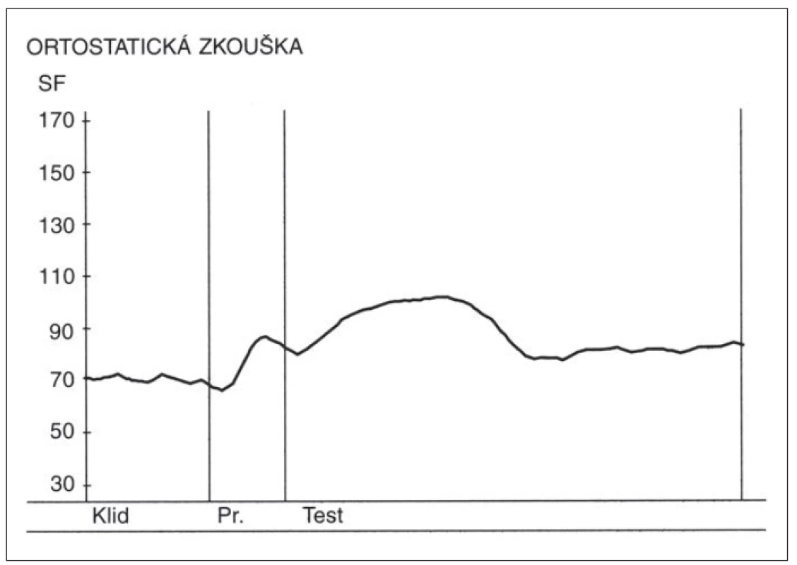 Změny srdeční frekvence (SF) v ortostatické zkoušce u zdravé osoby.
Nad osou x – křivka zobrazující změny srdeční frekvence v ortostatické zkoušce. Výchozí
kardioakcelerace následovaná kardiodecelerací vyvolanou vagem. Osa y – hodnoty srdeční
tepové frekvence za minutu.
Fig. 3. Heart rate changes during the orthostatic test in a healthy person.<br>
Above the x-axis – curve depicting heart rate changes during the orthostatic test. Initial
cardioacceleration followed by vagally induced cardiodeceleration. Y-axis – heart rate
(beats per minute).