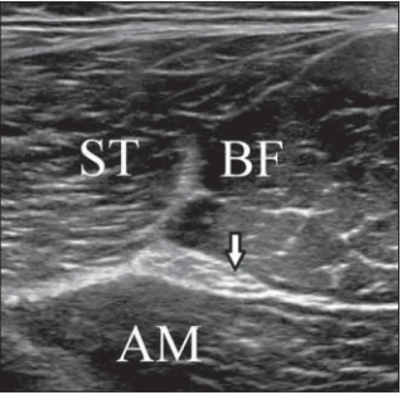 Transverse ultrasound image
of the sciatic nerve and muscles in the
dorsal thigh.<br>
Obr. 1. Příčný UZ obraz sedacího
nervu a svalů v dorzální části
stehna.