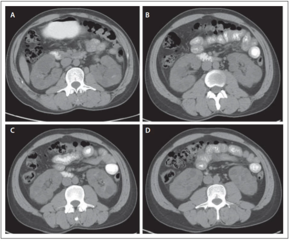Abdominal CT images. Bilateral renal polycystosis.<br>
Obr. 2. CT snímky břišní dutiny. Polycystóza ledvin oboustranně.