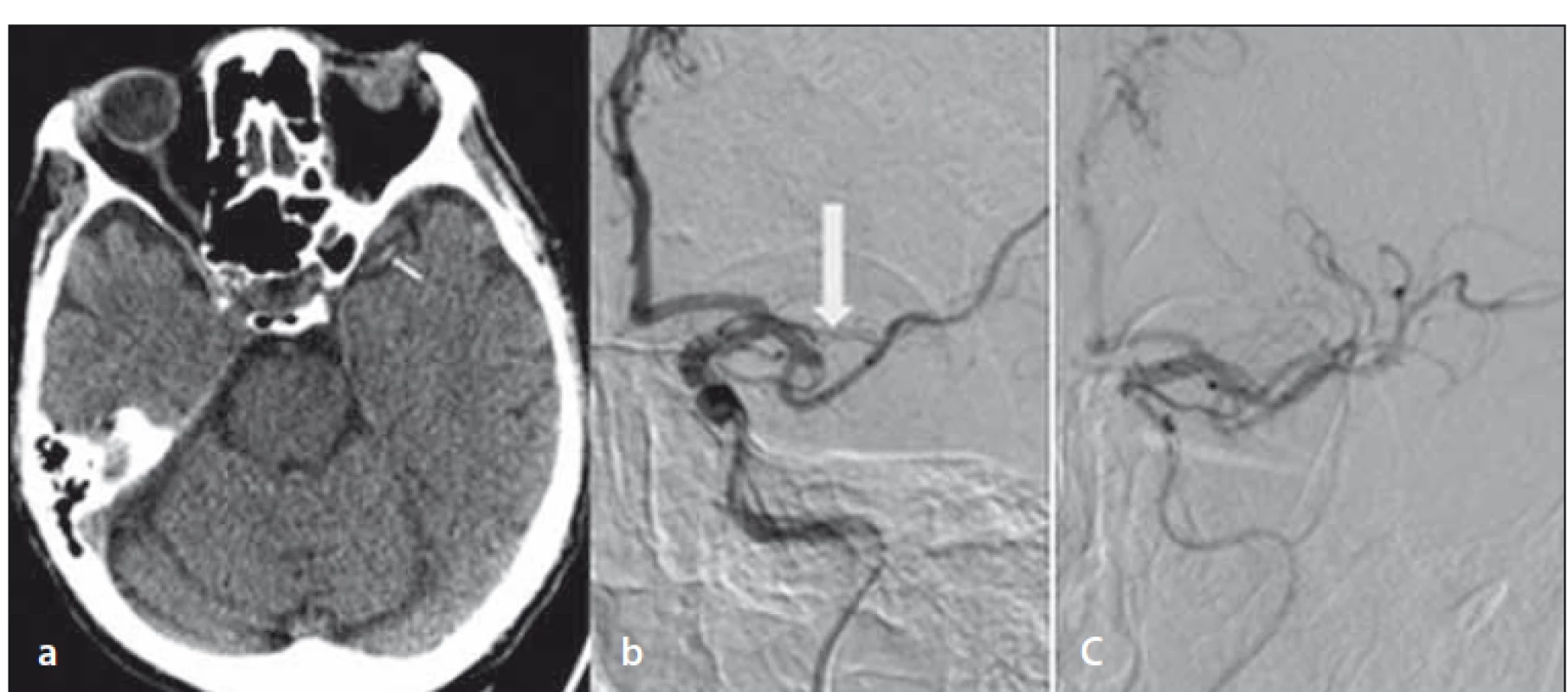 Opakované natívne vyšetrenie CT mozgu – dense artery sign a. cerebri media
vľavo (šípka) (a); DSA – oklúzia M2 vľavo (šípka) (b); DSA – kompletná rekanalizácia po
endovaskulárnej liečbe (c).<br>
Fig. 2. Repeated non-enhanced brain CT – dens artery sign in the left middle cerebral artery
(arrow) (a); DSA – occlusion of the left M2 (arrow) (b); DSA – complete recanalization
after endovascular treatment (c).