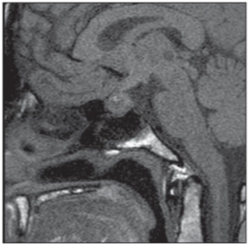 Apoplexie hypofýzy. Vyšetření MR,
sagitální nativní T1 snímek – objemové
zvětšení hypofýzy (vč. stopky) s nehomogenní intenzitou signálu a okrsky T1 hyperintenzit odpovídající prokrvácení.<br>
Fig. 5. Pituitary apoplexy. MRI scan,
sagittal T1-weighted image – enlargement of the pituitary gland (including pituitary stalk) with nonhomogeneous signal intensity and T1 hyperintense areas
corresponding bleeding.