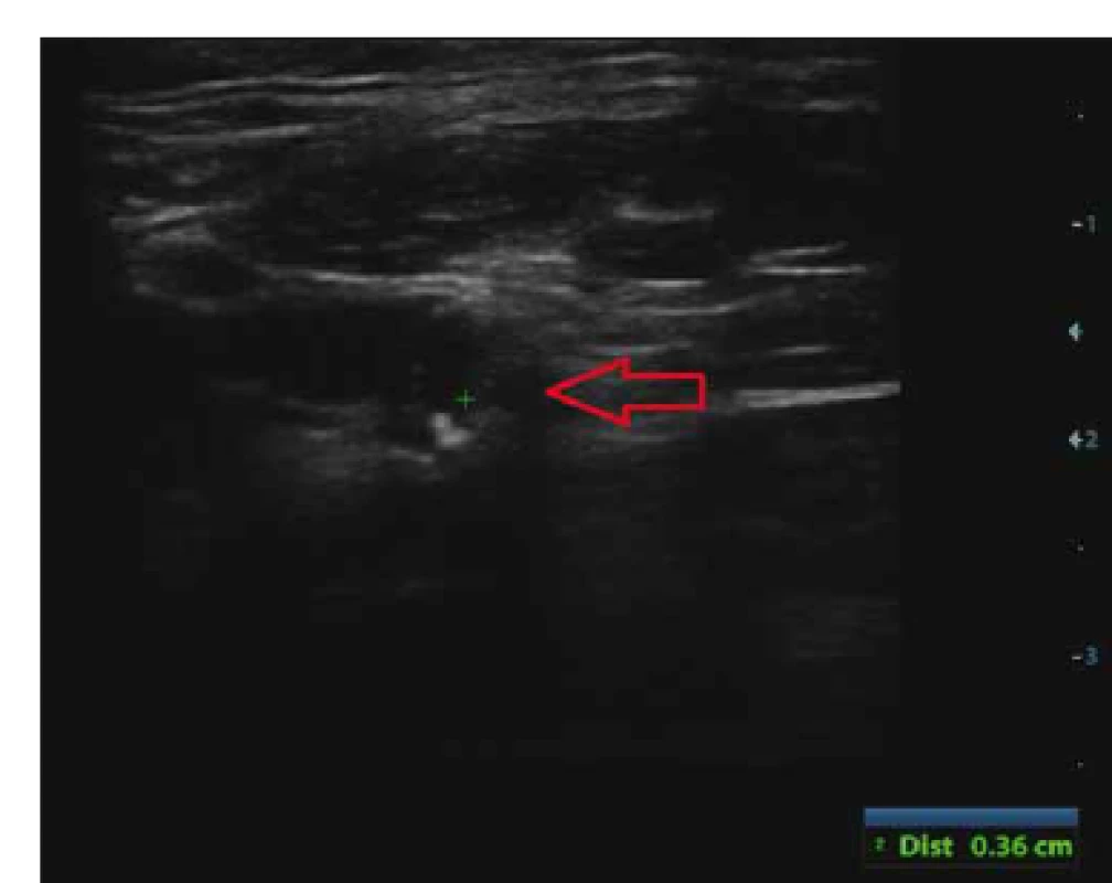 Echolucentní (anechogenní) část aterosklerotického plátu
> 8 mm<sup>2</sup> hodnocená jako krvácení do aterosklerotického plátu na
duplexní sonografi i.<br>
Fig. 1. Echolucent part of atherosclerotic plaque > 8 mm<sup>2</sup>
on duplex ultrasound evaluated as intraplaque hemorrhage