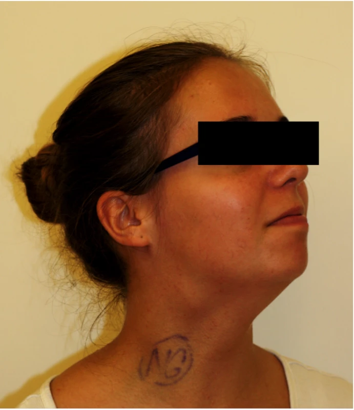 CBT located on the right side of the neck.