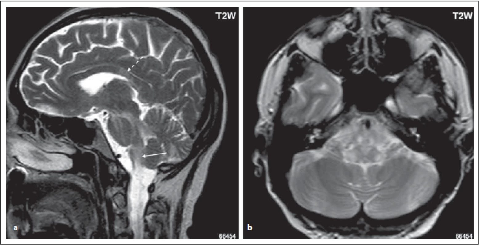 Pacient s MOG-IgGpozNMOSD, T2 vážený obraz, sagitální rovina řezu, zvýšený signál v oblasti dorzolaterální části oblongáty
(area postrema, tractus solitarius) (šipka). Dále je patrný zvýšený signál v oblasti středního mozečkového pedunkulu, v oblasti pontu
a mezencefalonu (a). Dále je patrné ložisko v oblasti corpus callosum, které je odlišného tvaru než u pacientů s RS (přerušovaná
šipka) (a). Ložiska v oblasti dorzolaterální oblongáty, zasahují do nucleus tractus solitarii bilat (b).<br>
Fig. 3. MOG-IgGposNMOSD patient, T2-weighted image, sagittal cut, hypersignal lesion in dorsal oblongata (area postrema, tractus
solitarius) (arrow); high signal in middle cerebellar peduncle, in pons and mesencephalon (a). Lesions in dorsal oblongata extend to
nucleus tractus solitari bilaterally (b). There is a lesion in corpus callosum with a diff erent shape than in MS patients (dashed arrow) (a).