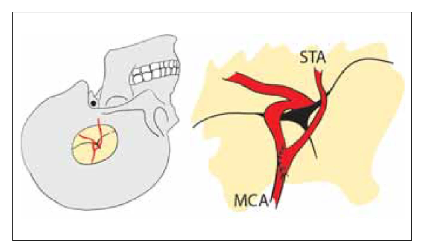 Přímá revaskularizace. Nízkoprůtokový end-to-side bypass
mezi STA a větví M4 MCA.<br>
MCA – arteria cerebri media; STA – arteria temporalis superfi cialis<br>
Fig. 7. Direct revascularization. Low-fl ow end-to-side bypass between
STA and M4 branch of the MCA.<br>
MCA – middle cerebral artery; STA – superfi cial temporal artery