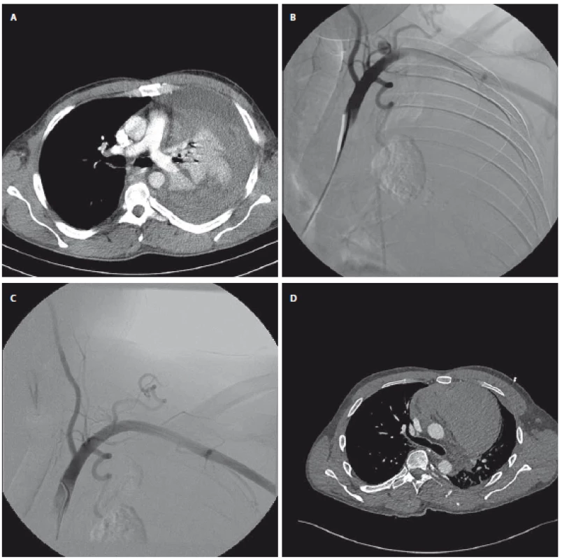 (A) Axiální řez z CTA s rozsáhlým hemotoraxem vlevo; (B) CTA s pseudoaneuryzmatem v povodí a. transversa colli vlevo; (C) kontrolní
CTA po embolizaci, vak pseudoaneuryzmatu se neplní; (D) axiální řez z CTA s velkým mediastinálním hematomem.<br>
Fig. 1. (A) Axial CTA scan with huge hemothorax on the left side; (B) CTA with pseudoaneurysm on the left subclavian artery; (C) angiogram
after embolization; (D) axial CTA scan with large mediastinal hematoma.
