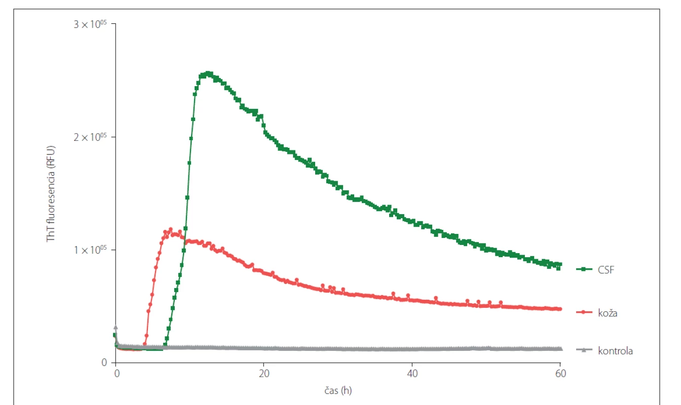 Prión konvertujúca aktivita vo vzorkách CSF a kože rovnakého sCJD (MM1) pacienta odobratých post-mortem analyzovaných
pomocou RT-QuIC metódy. Vzorky CSF boli analyzované neriedené a vzorky kože boli nariedené 10x.<br>
CSF – cerebrospinálna tekutina; RT-QuIC – Real-Time Quaking-Induced Conversion; sCJD – sporadická Creutzfeldt-Jakobova choroba; ThT –
Thioflavín T<br>
Fig. 3. Prion seeding activity in CSF and skin samples obtained post-mortem from the same patient with sCJD (MM1) diagnosis analyzed
using RT-QuIC assay. CSF samples were analyzed undiluted and the skin samples were diluted 10x.<br>
CSF – cerebrospinal fluid; RT-QuIC – Real-Time Quaking-Induced Conversion; sCJD – sporadic Creutzfeldt-Jakob disease; ThT – Thioflavin T