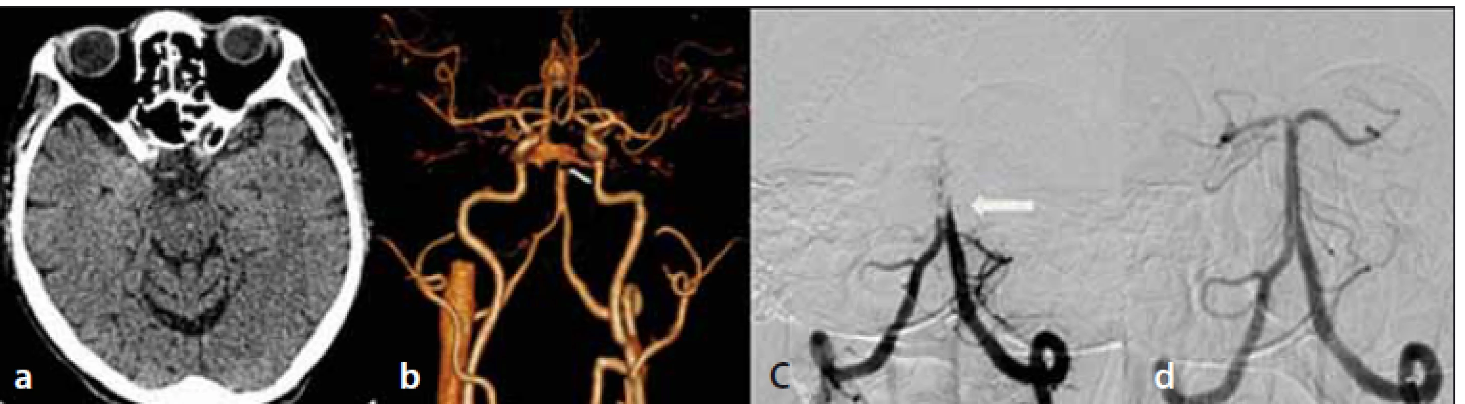 Natívne vyšetrenie CT mozgu – bez akútnych ložiskových zmien (a); CTA – oklúzia
vrcholu a. basilaris (šípka) (b); DSA – oklúzia a. basilaris (šípka) (c); DSA – kompletná rekanalizácia
oklúzie a. basilaris (d).<br>
Fig. 1. Non-enhanced brain CT – without acute ischemic lesions (a); CTA – top-of-basilaris
occlusion (arrow) (b); DSA – occlusion of basilar artery (arrow) (c); DSA – complete recanalization
of basilar artery occlusion (d).