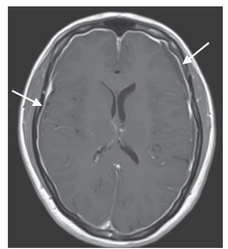 MR mozku v T1 váženém postkontrastním obraze ukazující
hladké pachymeningeální sycení.<br>
Fig. 1. Brain MRI contrast-enhanced T1-weighted image showing
diffuse pachymeningeal enhancement.