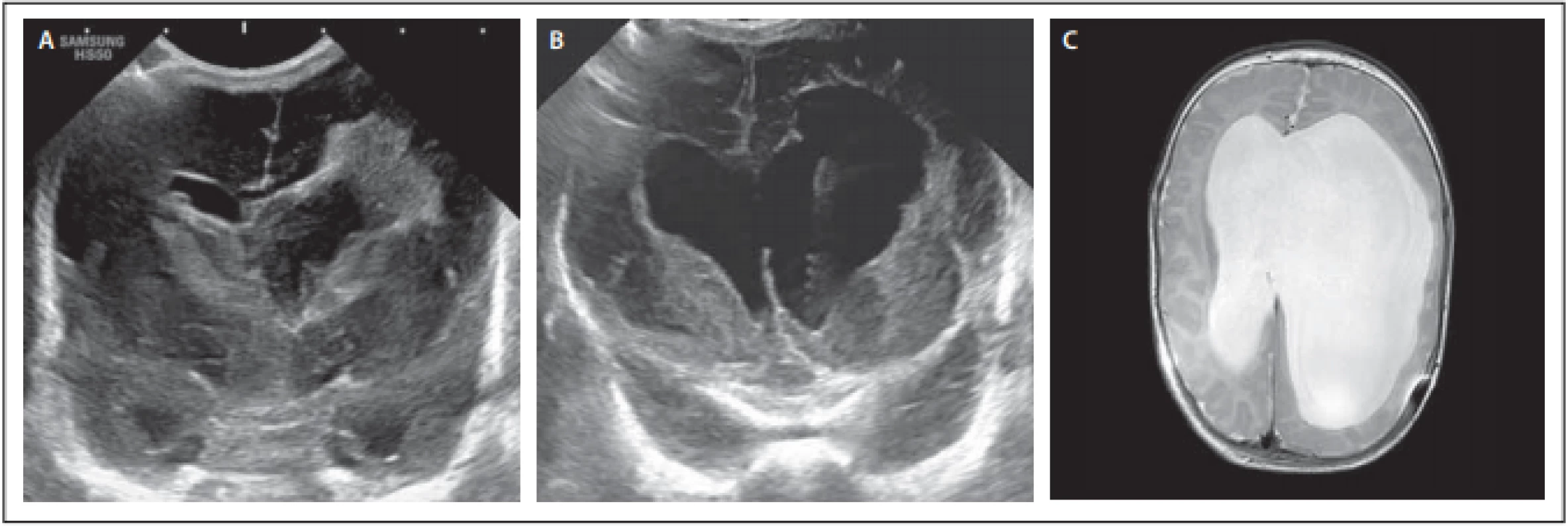 Pacientka 1 – (A) předoperační sonografi e s viditelnými koaguly v obou postranních komorách s extenzí periventrikulárně
vlevo; (B) pooperační sonografický snímek se zachyceným katetrem podkožního portu; (C) MR mozku před implantací shuntu.<br>
Fig. 1. Female patient 1 – (A) preoperative sonography with visible blood clots in both lateral ventricles with periventricular extension
to the left; (B) postoperative sonography with visible subcutaneous port catheter; (C) MRI of the brain before shunt implantation.
