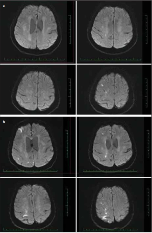 Difúziou vážená MR mozgu, b1000 – (a) predoperačný nález akútnej ischemie; 
(b) nález po zhoršení klinického stavu.<br>
Fig. 5. Brain MR diff usion weighted image, b1000 – (a) acute ischemia before surgery; 
(b) after clinical deterioration.