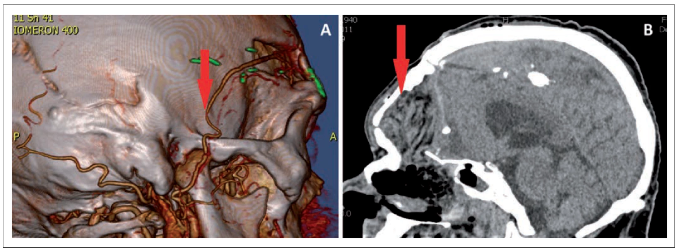 A – CTA, the arrow shows the arterial anastomosis, B – CT scan after 2 days from the operation, the arrow shows the flap.<br>
Obr. 2. A – CTA, šipka ukazuje arteriální anastomózu, B – CT po 2 dnech od operace, šipka ukazuje lalok.