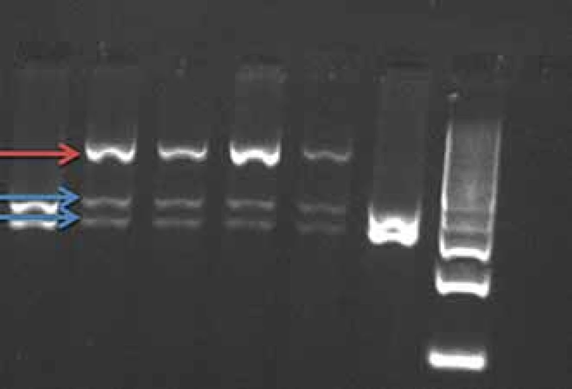 Restrikce produktu enzymem
BsmA1 v genu PRNP (mutace E200K).
Mutace E200K ruší restrikční místo pro
enzym BsmA1.
Červená šipka – neštěpený fragment mutované
alely, délka 608 bp
Modré šipky – štěpený fragment „wild type“
alely, délka 260–348 bp<br>
Fig. 1. BsmA1 restriction of PCR product
gene PRNP (mutation E200K). The E200K
mutation cancels the BsmA1 restriction
site.
Red arrow – uncut fragment of the mutated
allele, length 608 bp.
Blue arrows – split fragment of the wild-
-type allele, length 260–348 bp.