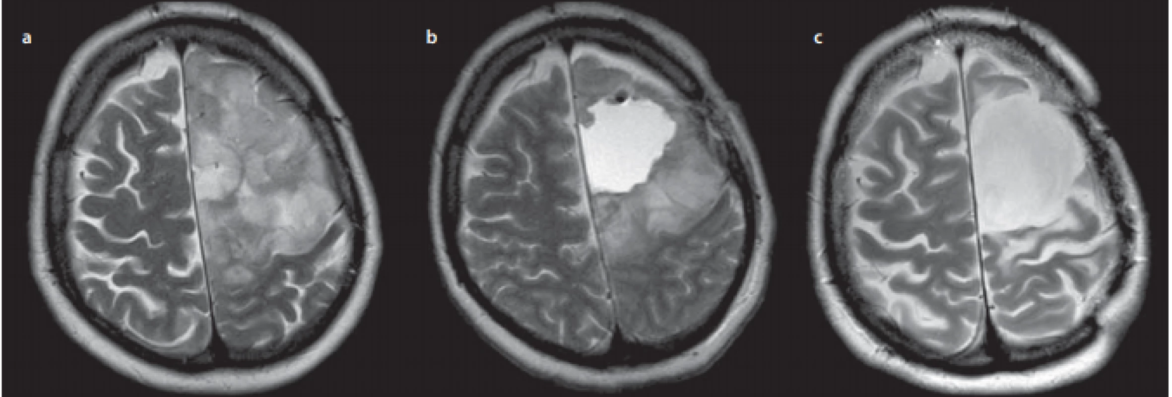 MR, T2 axiální skeny – 45letá pacientka operovaná v roce 2010 pro difuzní infiltrativní fibrilární astrocytom (skupina NE), 
původně neindikovaný k operaci, pacientka měla několikrát denně generalizovaný epileptický záchvat.<br>
Fig. 4. T2WI MRI, axial scans – 45-year-old female patient operated on in 2010 for diffuse infi trative fibrillary astrocytoma (group NE); initially 
not indicated for surgery, but the patient had several generalized epileptic seizures daily.