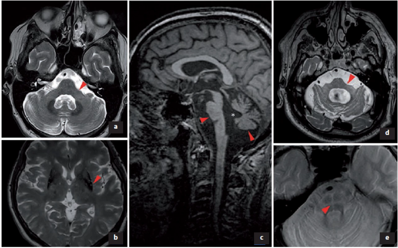 Změny v MR podporující diagnózu multisystémové atrofie.<br>
a) V T2 obraze atrofie pedunculi cerebellares medii; b) snížený signál v T2 obraze svědčící pro akumulaci železa v dorzální a laterální části
put a men bilaterálně, atrofie putamen; c) v T1 obraze atrofie pontu a cerebela, * rozšíření IV. mozkové komory; d) zvýšení signálu v T2 obraze
v pedunculi cerebellares medii bilaterálně, extrémní atrofi e pontu; e) v T2 obraze hot cross bun sign (příznak žemle).<br>
Fig. 2. Changes in MRI supporting the diagnosis of multiple system atrophy.<br>
a) In T2 image atrophy of pedunculi cerebellares medii; b) reduced signal in T2 image was indicative of accumulation of iron in the dorsal
and lateral parts of the putamen bilaterally and atrophy of the putamen; c) pontine and cerebellar atrophy in a T1 image, * enlargement of
the IVth ventricle; d) increase of T2 image signal in pedunculi cerebellares medii bilaterally and extreme pontine atrophy; and e) hot cross bun
sign in a T2 image.